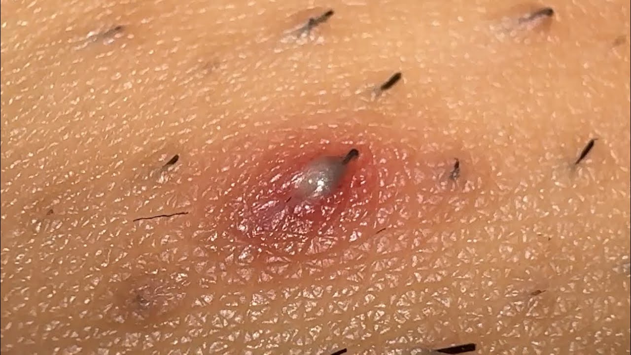 **JUICY** SATISFYING INGROWN HAIR PULL😍😍😍 YouTube