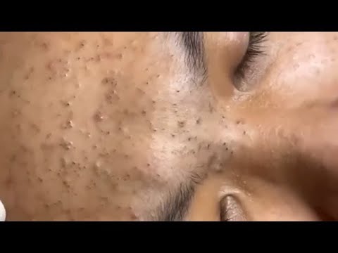 😁 Removing Blackheads - Relaxing Video