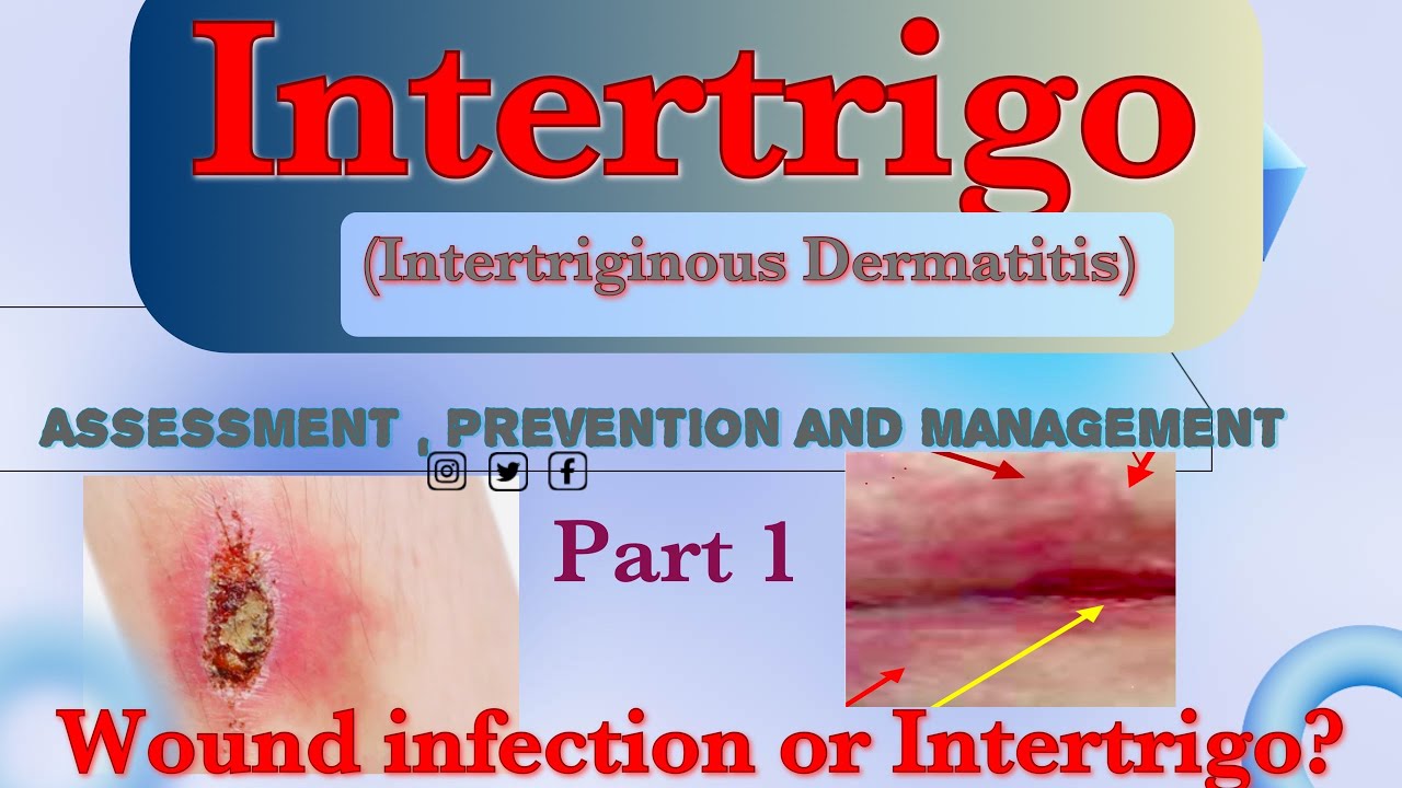 Intertrigointertriginous Dermatitis Assessment Prevention And