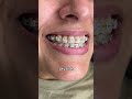 Braces Colors Before and After 8 weeks