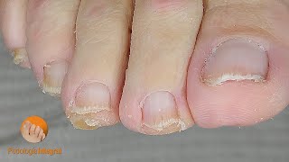 Comfort returns to tired feet! | Podological cleaning of toenails and calluses [Podología Integral]