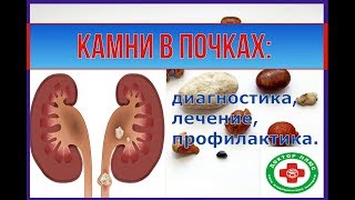 Камни в почках: диагностика, лечение, профилактика.