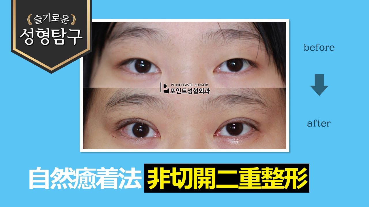 【韓国二重整形】自然癒着法の二重整形症例(手術直後)