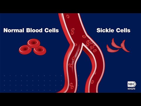 UCSF, Berkeley, UCLA to Launch Sickle Cell Trial Using CRISPR