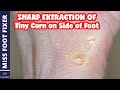 How To Remove TINY CORNS From Foot | Foot Side Tiny Corns Removal 2022 - By Miss Foot Fixer