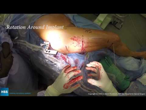 Precice Femur Lengthening: Live Surgery by Dr. Rob Rozbruch