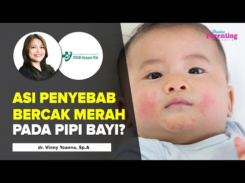 Penyebab Bercak Merah Pada Pipi Bayi, Apakah Karena Asi? | Dunia Parenting Indonesia