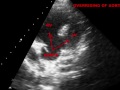 TETRALOGY  OF  FALLOT (TOF) - ECHOCARDIOGRAPHY  SERIES BY DR. ANKUR K. CHAUDHARI.