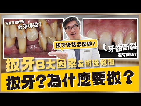 【隱適美矯正 #23】拔牙全攻略！植牙和矯正前為什麼要拔牙?怎麼拔牙?拔牙之後怎麼辦?8大因素告訴你【醫師說重點】｜【祐民牙醫－隱適美旗艦店】鑽石級楊大為醫師 #拔牙 #植牙 #矯正牙齒