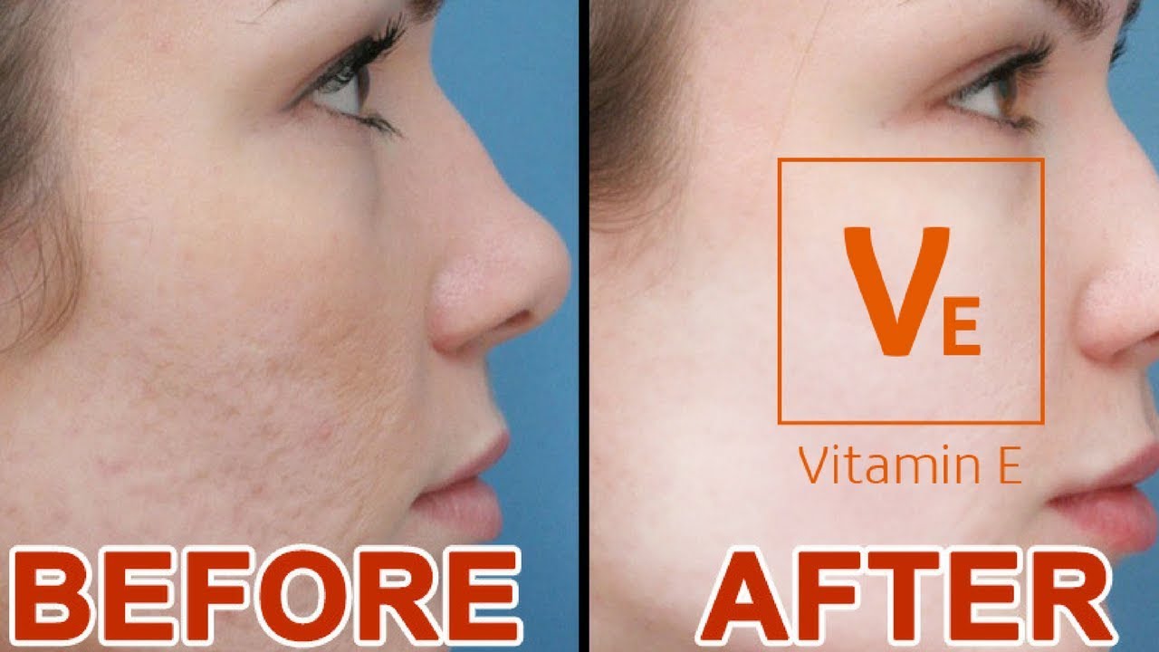Vitamin E For Acne Scars Before And After VitaminWalls