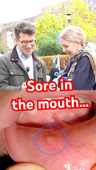 What is this sore in the mouth? #shorts #mouthulcer #cankersores  #mouthsores