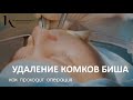 Удаление комков БИША - хирург Владимир Косинец