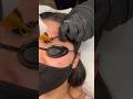 Burning off my eyebrow tattoo… Ouch