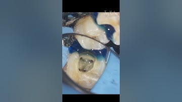 Radix Entomolaris #endodontist #microendodontist