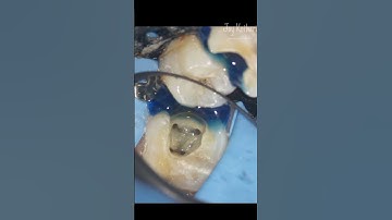 Radix Entomolaris #endodontist #microendodontist