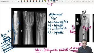 Colles' fracture - Reduction and plaster application