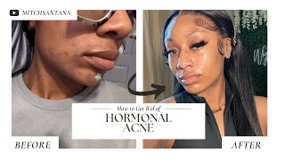 How I Cleared My Hormonal Acne | Overhyped Products I What Cleared My Skin + My Real Routine