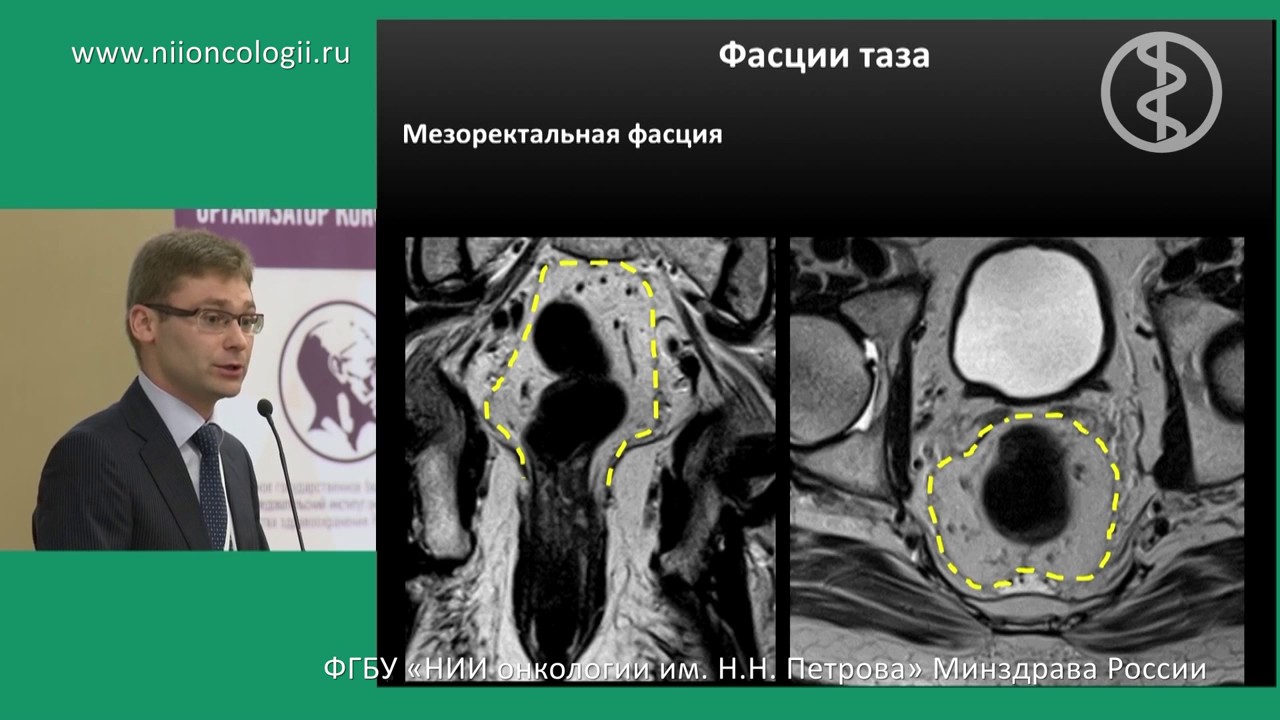 Рак прямой кишки МРТ в стадировании и оценке лечения - YouTube