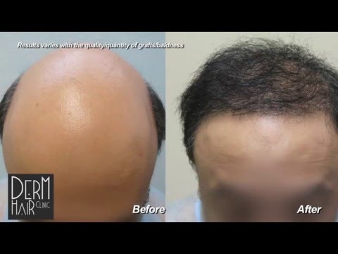 FUE hair restoration and Body hair transplant for severe baldness - Dr Umar