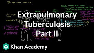 Extrapulmonary TB (Part 2) | Infectious diseases | NCLEX-RN | Khan Academy