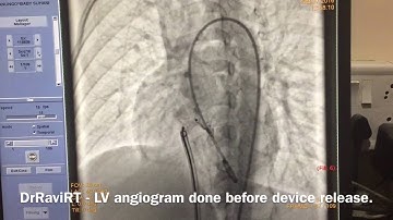 DRRAVIRT - TRANSCATHETER DEVICE CLOSURE OF LARGE VSD