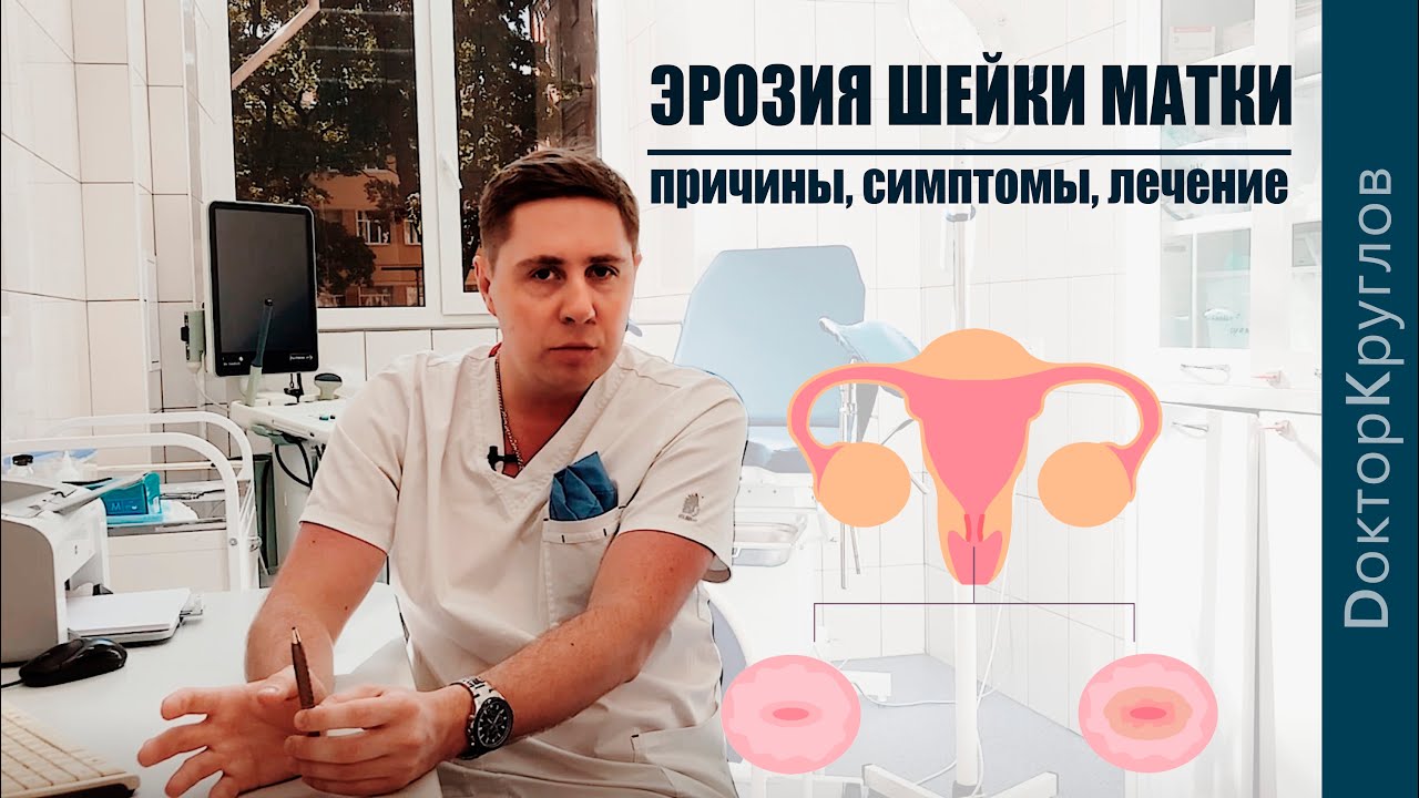 ЭРОЗИЯ и эктопия шейки матки | чем ОПАСНА | ВСЁ о диагностике ...
