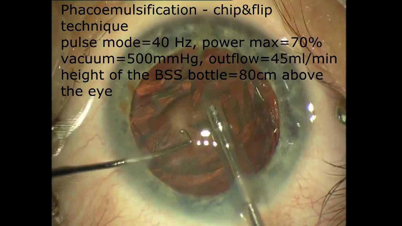 Multifocal lens in cataract surgery YouTube