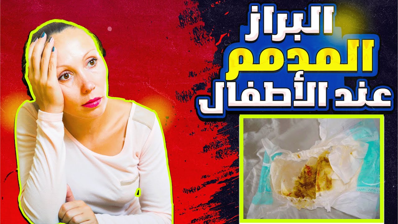 متى يكون نزول الدم مع البراز خطير- اخطر سبب نزول دم فى براز الطفل وقد يهدد حياته
