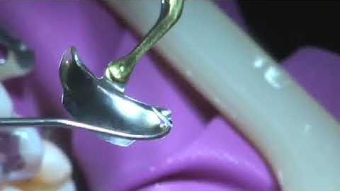 Palodent® Plus- Avoiding Excess Flash | Dentsply Sirona