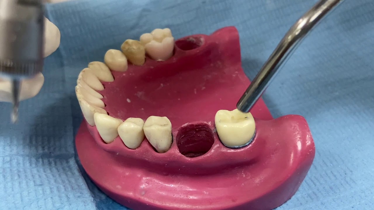 Preparation of a class I cavity with buccal extension for lower molars
