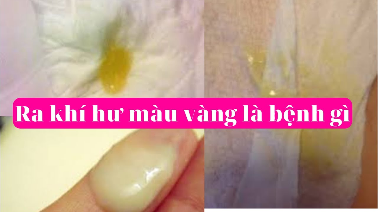 Ra khí hư màu vàng là bệnh gì? What disease is yellow discharge
