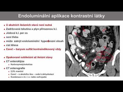 Video: Apendikulární Infiltrát - Příčiny, Příznaky, Diagnostika A Léčba Apendikulárního Infiltrátu