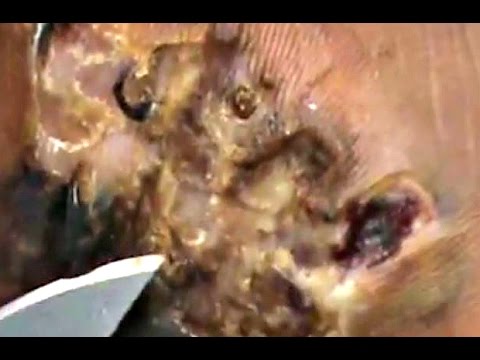 shadrack-(15)-growing-colony-of-jiggers-destroyed!