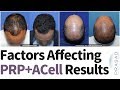 ACell + PRP for Hair Loss - Why Hair Restoration Experience is Important for Successful Treatment