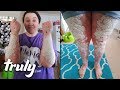 My Body Is 90% Covered In Psoriasis | TRULY