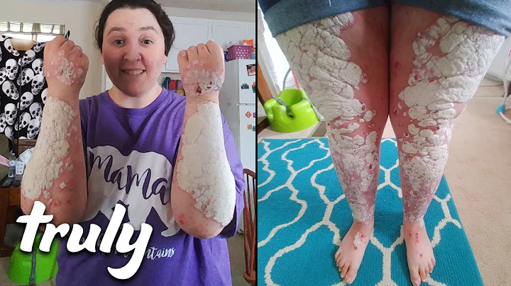 My Body Is 90% Covered In Psoriasis | TRULY - DayDayNews