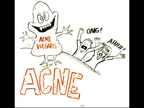 What is the Best Way to Treat Acne?
