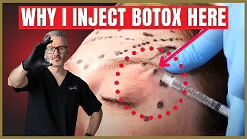 How To Inject Botox Under The Brow | Botox Brow Lift Advice