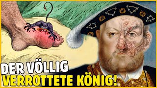 Die Gruseligen Krankheiten Von Heinrich Viii., Die Du Nicht Kanntdest