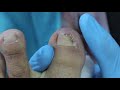 Ep_487 Ingrown nail removal 👣 เล็บน้องห่อจนห้อเลือด ขอบคุณ FC จากพัทยา