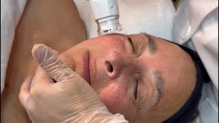 DEHAZ Anti-aging and sun damage correction facial with cold plasma &amp; TAUREG Peel.