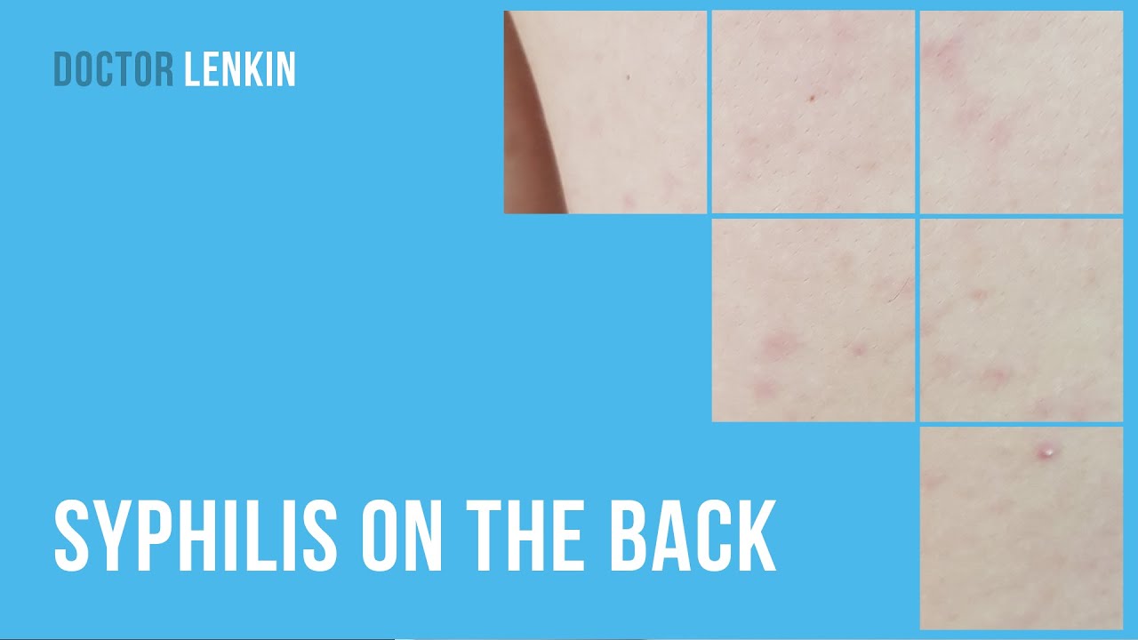 Syphilis Rash To Back Syphilis Lower Back Pain _ Syphilis: Cause, Symptoms, Diagnosis ...