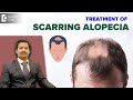 Scarring alopecia treatment  patchy hair loss  hair regrowt.rdeepak p devakar doctors circle