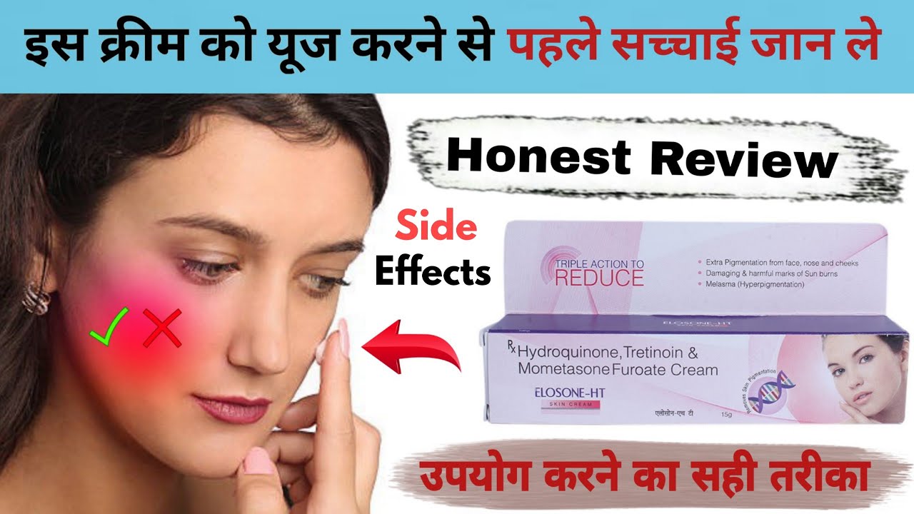 Elosone ht skin cream||Elosone ht skin cream kaise use kare||Elosone ht skin cream side effects