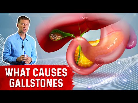 What Really Causes Gallstones?