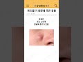여드름(?) 때문에 죽은 왕들