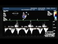 Hot Tips - Calculating the Aortic Valve Area Using the Continuity Equation