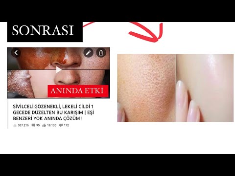 BEĞENİ REKORU KIRAN TARÇIN MASKESİ SONRASI HEMEN YAPILMASI GEREKEN MUCİZE MASKE | KIZARIKLIK YOK !