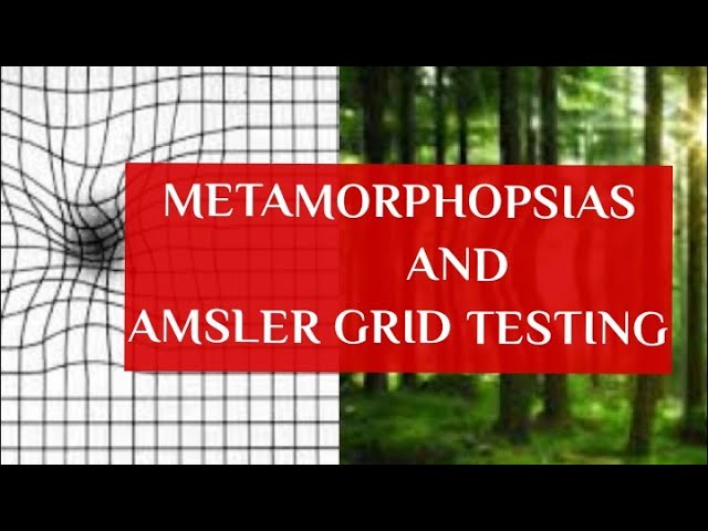 How to use an Amsler Grid – Front Range Retina