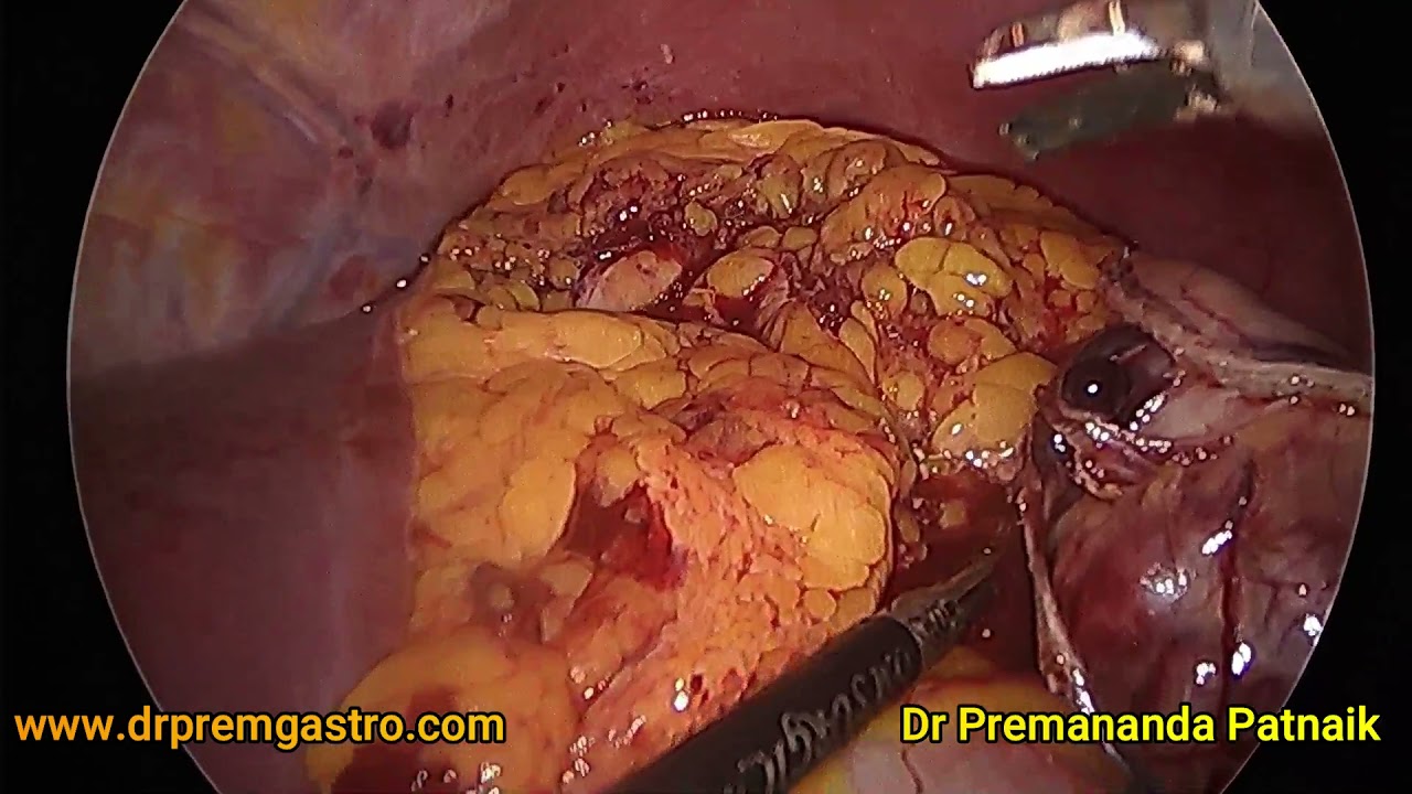 LAPAROSCOPIC STOMACH GIST EXCISION